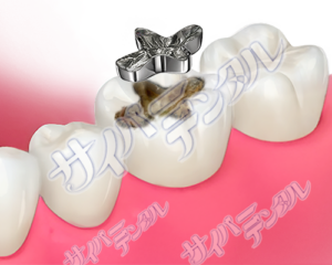 虫歯【二次カリエス】
