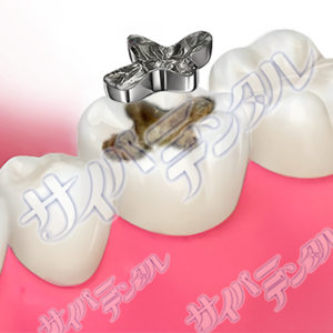 虫歯【二次カリエス】