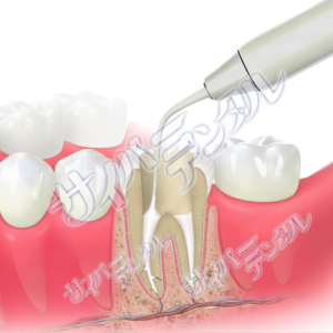 根管充填【垂直加圧】(大臼歯)1