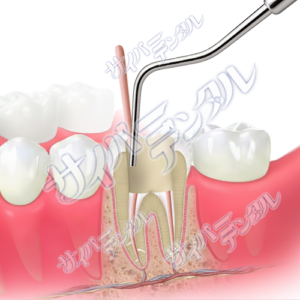 根管充填【垂直加圧】(大臼歯)3