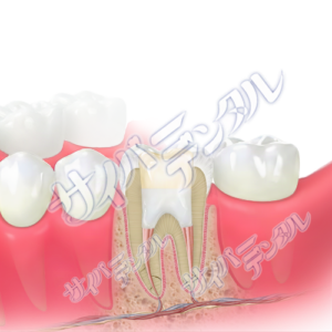 根管充填【側方加圧】(大臼歯)3