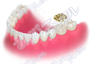 オーバーレイ-（全顎）ゴールドU
