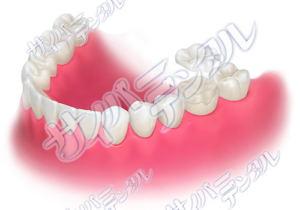 オーバーレイ-（全顎）ホワイトU