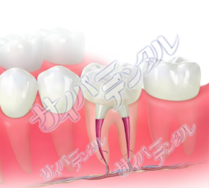 コア（大臼歯）ファイバー