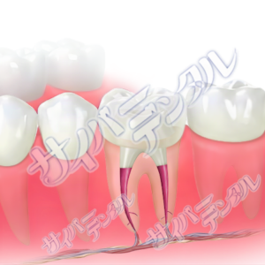 コア（大臼歯）ファイバー