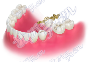 インレーブリッジ（全顎）-ゴールドU