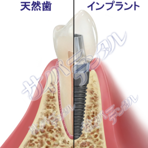 インプラント・天然歯【比較】