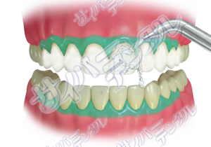オフィスホワイトニング【洗浄C】