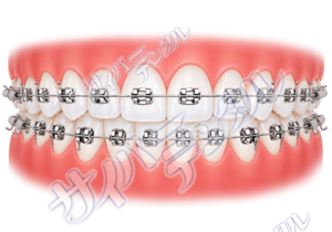 矯正装置【メタル】