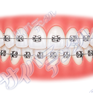 矯正装置【メタル】
