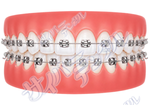 矯正装置【メタル】