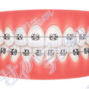 矯正装置【メタル】
