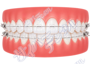 矯正装置【上下セラミック】
