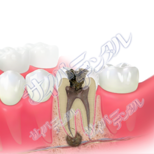 根管治療(大臼歯)-根尖病巣