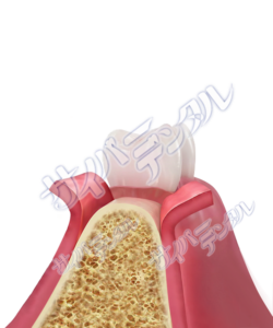 インプラント【治療・切開】切開