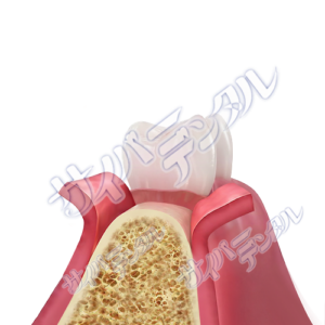 インプラント【治療・切開】切開