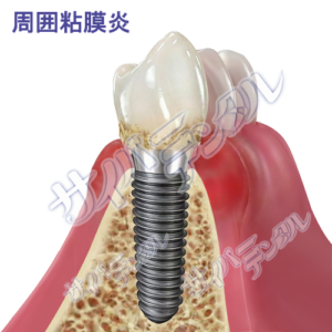 インプラント【周囲炎】周囲粘膜炎