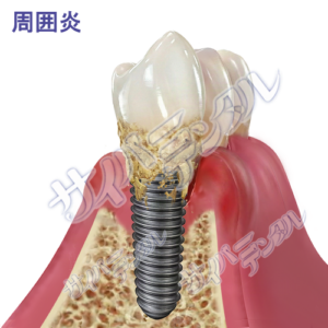 インプラント【周囲炎】周囲炎